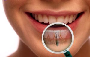 implanty zębów